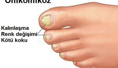 Tırnak Mantarı Nasıl Geçer Tırnak Mantarı Nasıl Geçer