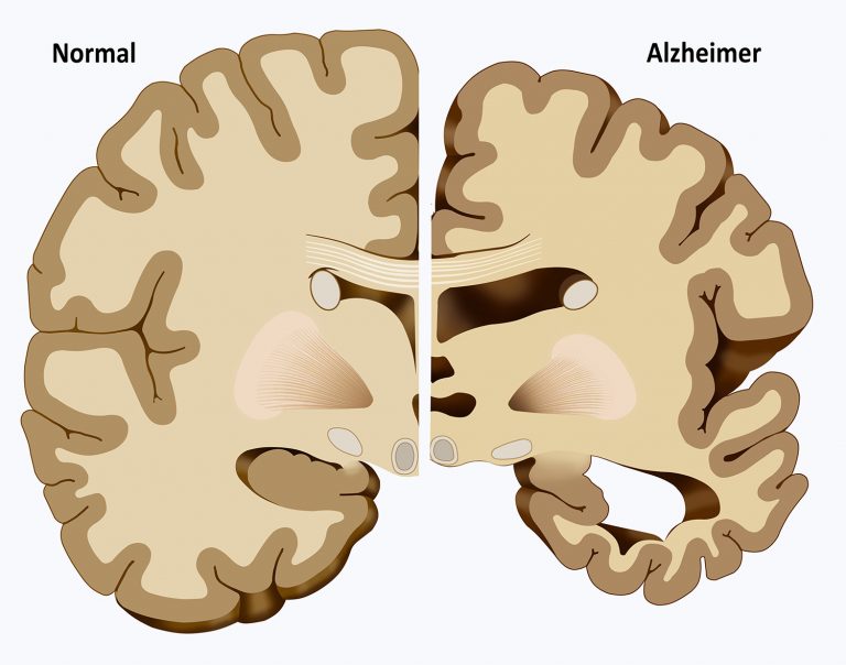 alzheimer hastalığı yakalanma faktörleri